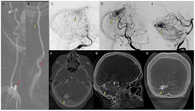 Case Report: Anterior Spinal Cord Ischemia Following Embolization of Cerebellar Arteriovenous Malformation: An Illustrative Case and Review of Spinal Cord Vascular Anatomy